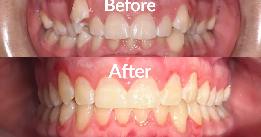 Orthodontics Before and After 2