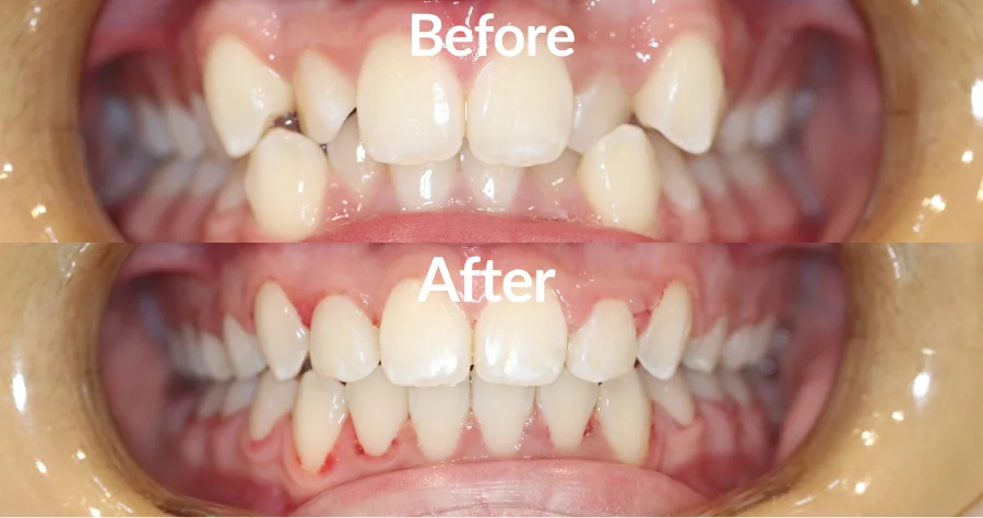 Orthodontics Before and After