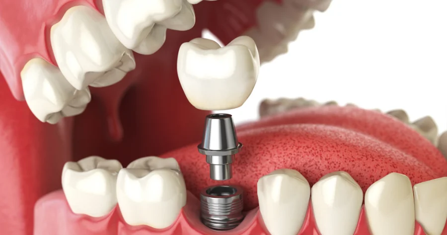 implant