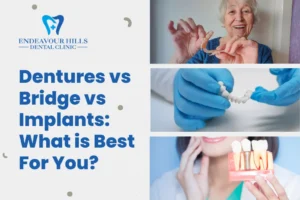 Dentures vs Bridges vs Implants: What is Best For You