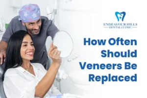 How Often Should Veneers Be Replaced?