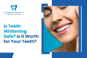 Is Teeth Whitening Safe? Is it Worth for Your Teeth?