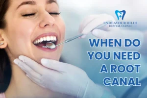 When Do You Need a Root Canal?