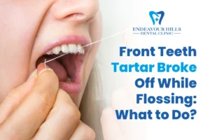 Front Teeth Tartar Broke Off While Flossing: What to Do?