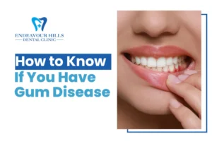 How to Know If You Have Gum Disease