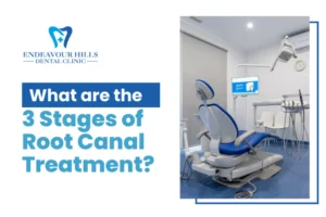 What are the 3 Stages of Root Canal Treatment?