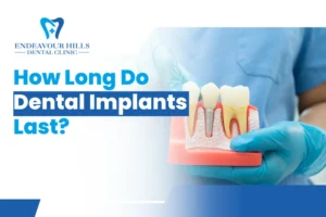 How Long Do Dental Implants Last?