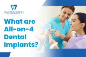 What are All-on-4 Dental Implants?