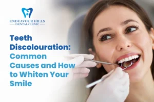 Teeth Discolouration: Common Causes and How to Whiten Your Smile