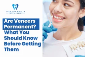 Are Veneers Permanent? What You Should Know Before Getting Them