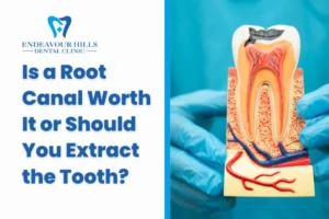 Is a Root Canal Worth It or Should You Extract the Tooth?
