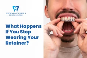 What Happens If You Stop Wearing Your Retainer?